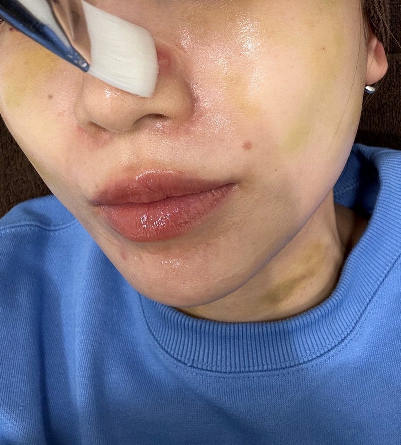 桃 クリニックでニキビを焼く施術の画像