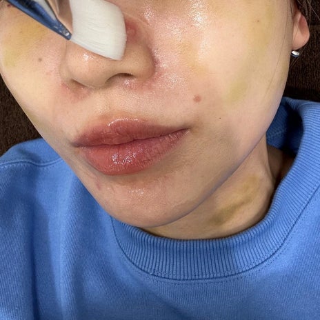 桃 クリニックでニキビを焼く施術の画像