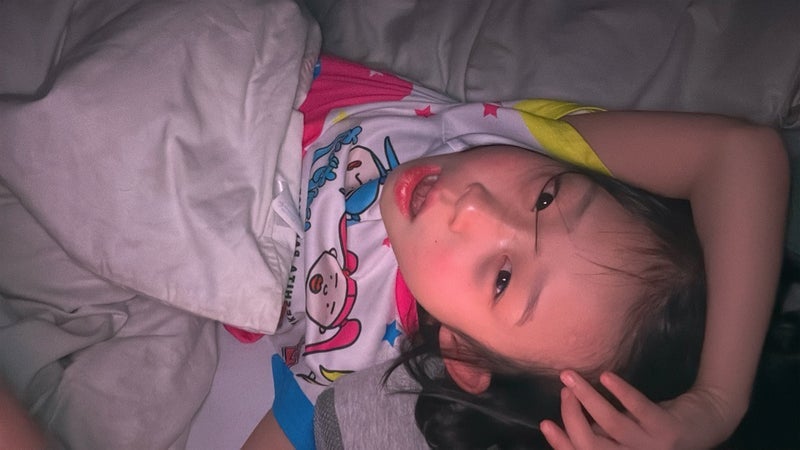 携帯を顔に落としてできた青タンの画像