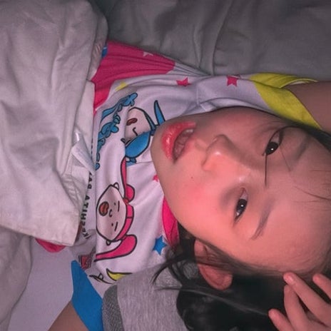 携帯を顔に落としてできた青タンの画像