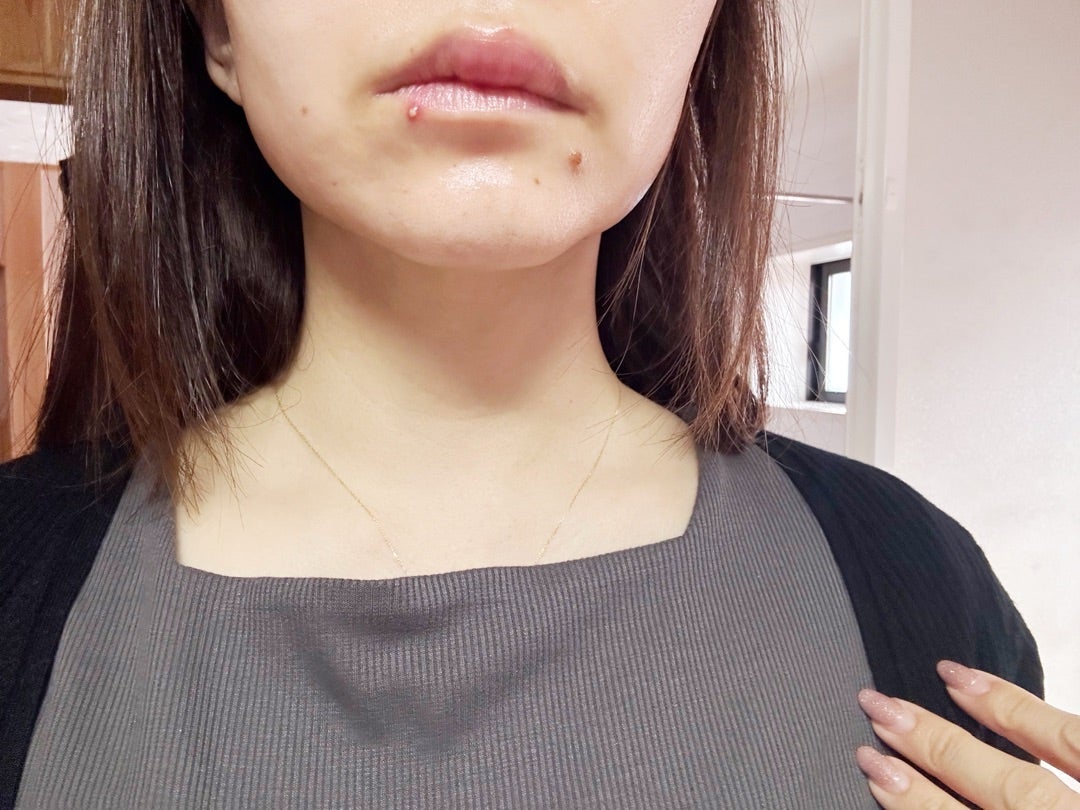 義実家帰省中に突然腫れた唇