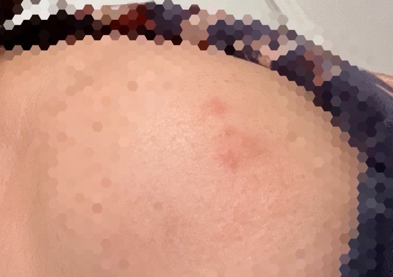 ホテルにいたヒアリの強烈なお土産の画像