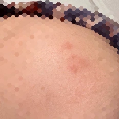 ホテルにいたヒアリの強烈なお土産の画像