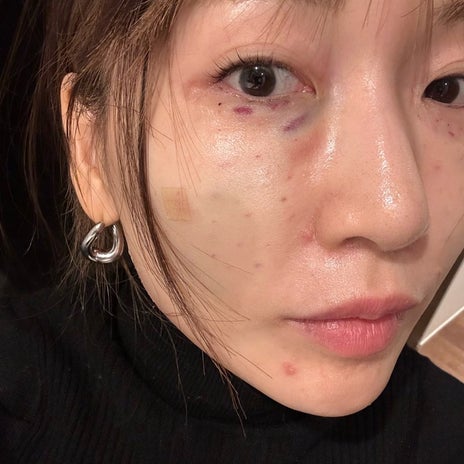 桃 転倒し顔を打った母の青あざの画像