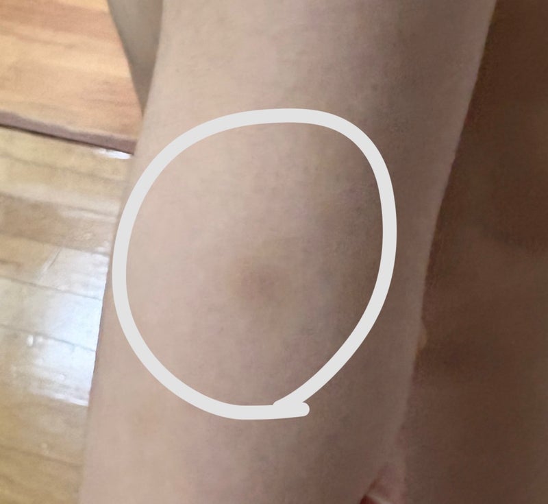 息子の体にあざを作る旦那の暴力の画像