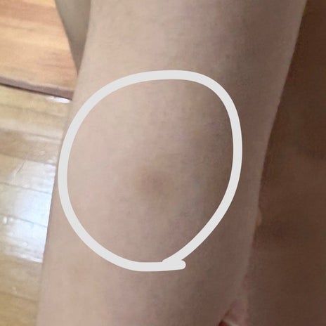 息子の体にあざを作る旦那の暴力の画像