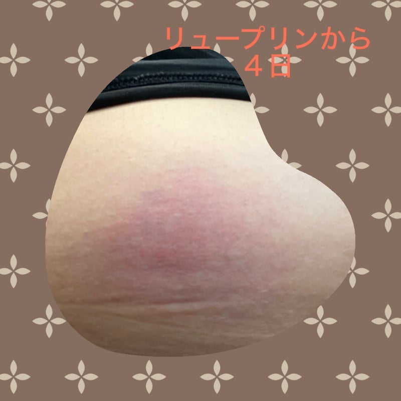 お腹への注射による3cmのしこりの画像