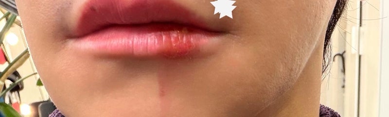 ヒデ 火傷の腫れと痛みで病院の画像