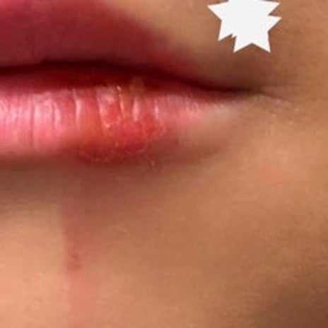 ヒデ 火傷の腫れと痛みで病院の画像