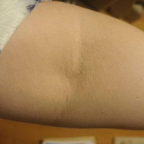 健康診断で聞かれた皮膚病の病名の画像