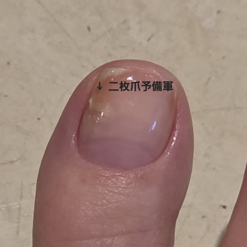 治療で二枚爪になりかけた親指のケアの画像