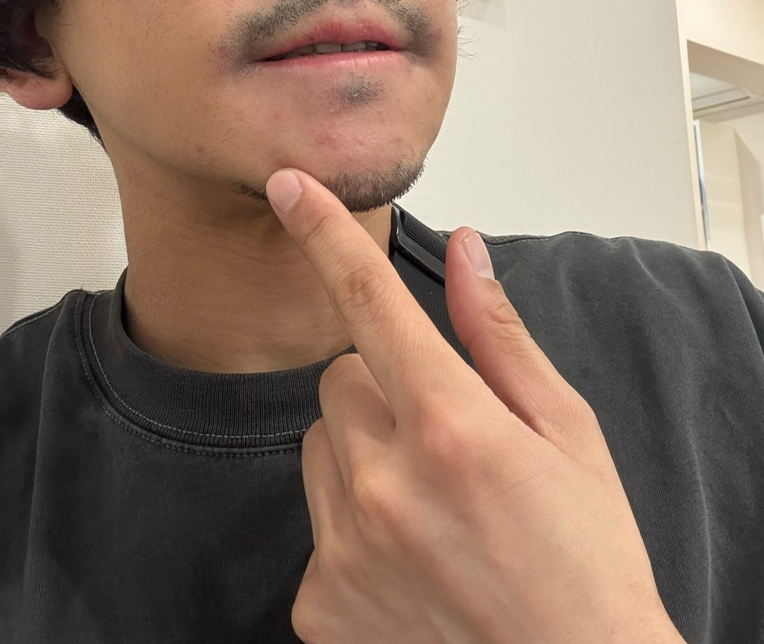 ヒデ また変わったアトピーの薬