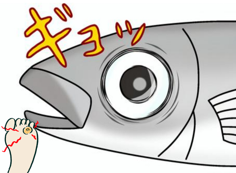 歩行困難な激痛の隠れていた魚の目の画像