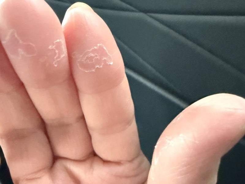 副作用で皮がめくれて痛い手の指の画像