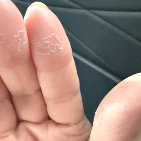 副作用で皮がめくれて痛い手の指の画像