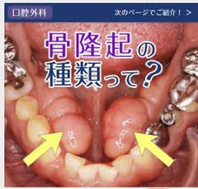 口ゴボの原因になる骨隆起のオペの画像