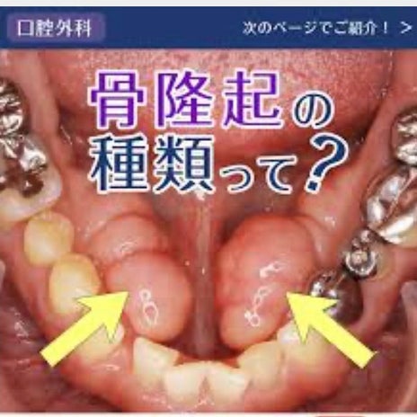 口ゴボの原因になる骨隆起のオペの画像