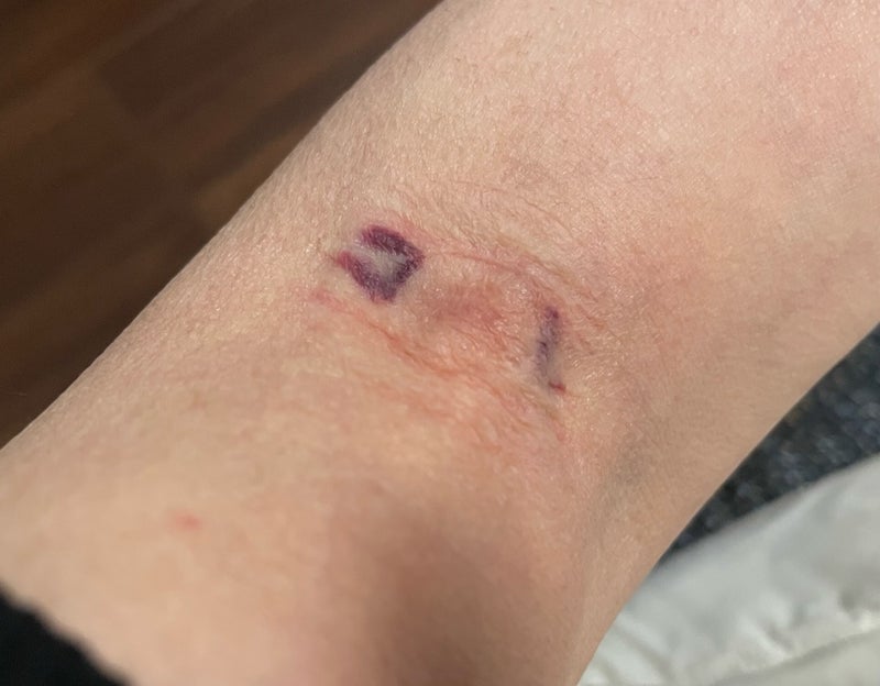 採血後にできた不思議な形の内出血の画像