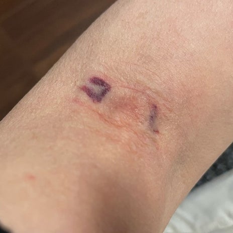 採血後にできた不思議な形の内出血の画像