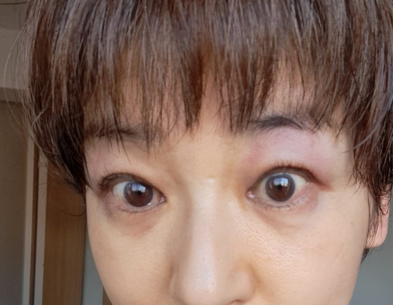 原因不明の酷い鼻水と両目の腫れの画像