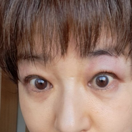 原因不明の酷い鼻水と両目の腫れの画像